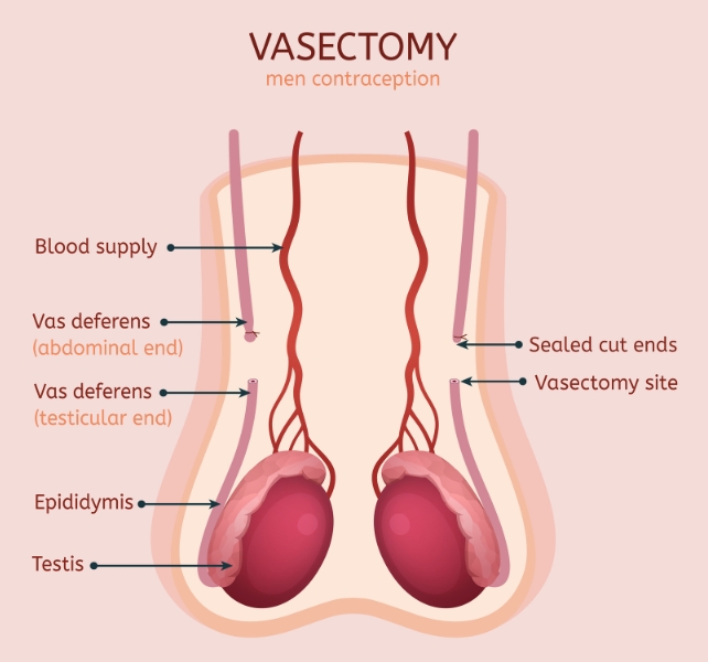 vasectomy diagram
