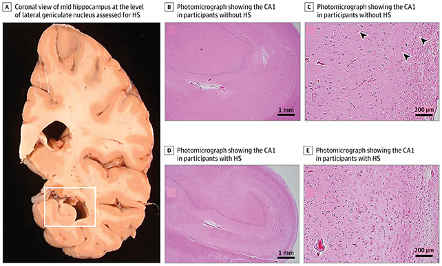 Brain scan