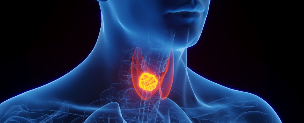 Concerns Emerge Over Potential Cancer Links to Drugs Like Ozempic : ScienceAlert