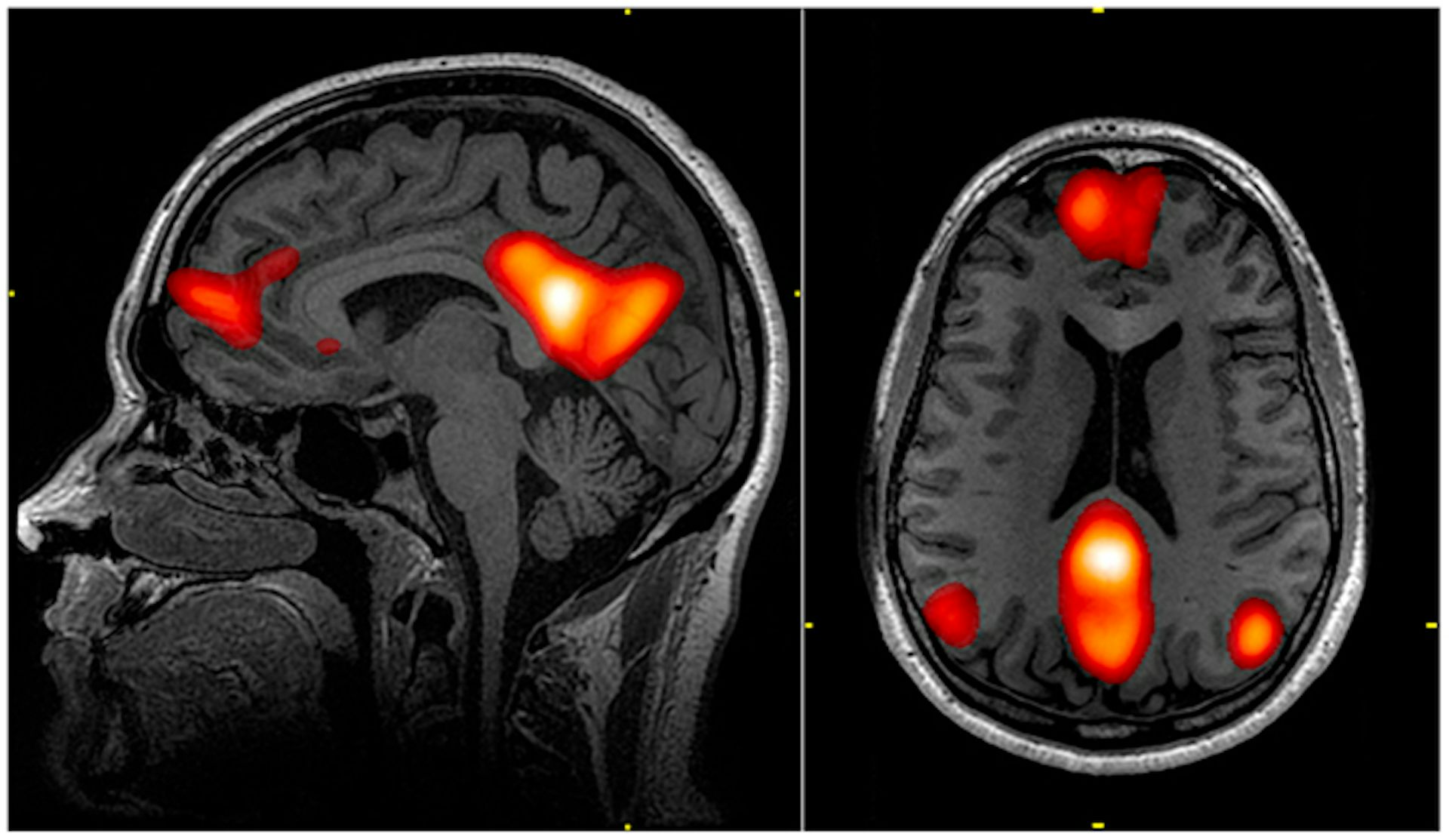 Brain scan images with default mode network highlighted