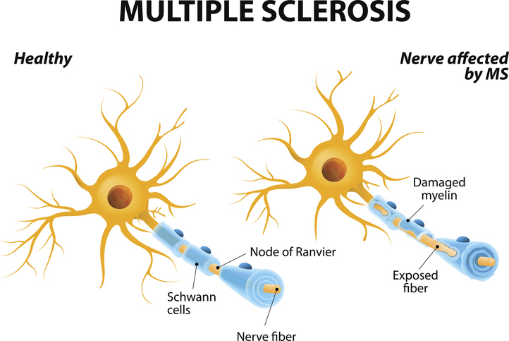 Diagram of neuron damage in MS