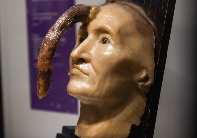 wax model of woman with growth on forehead