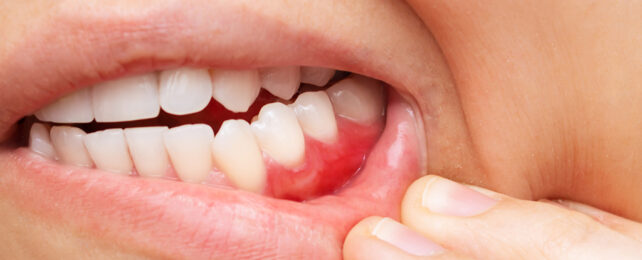 Bad gums