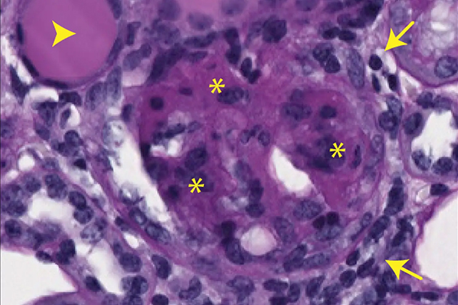Kidney scarring image