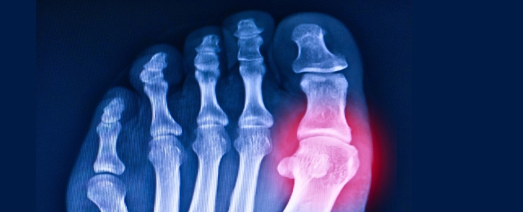 Scientists Revive 20-Million-Year-Old Gene to Help Fight Gout : ScienceAlert