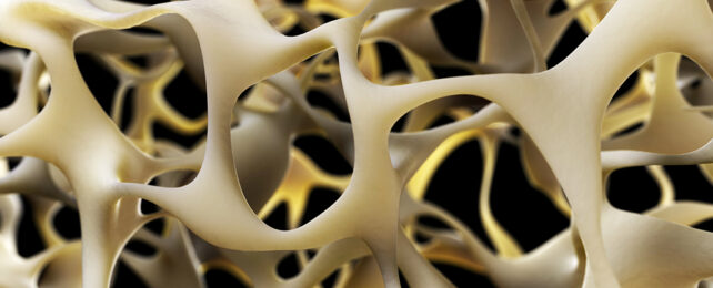Osteoporosis illustration