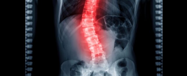 X-ray image of a spine with a curved section glowing red