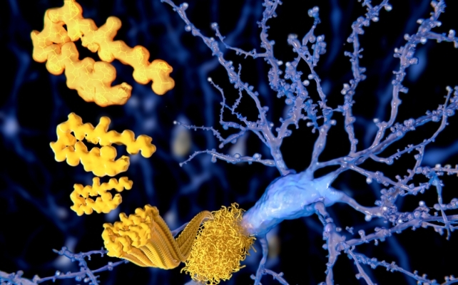 amyloid plaques