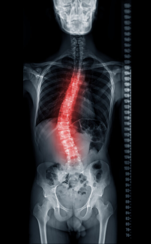Back Pain? The Curves in Your Spine Might Be to Blame.