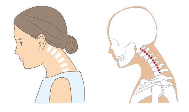 Back Pain? The Curves in Your Spine Might Be to Blame.