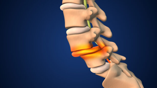 Back Pain? The Curves in Your Spine Might Be to Blame.