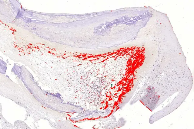 Your Own Mouth Bacteria Could Give You a Heart Attack