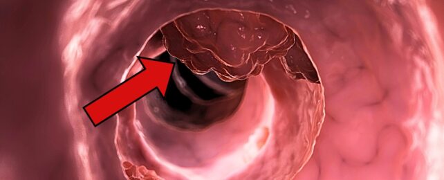 colorectal cancer