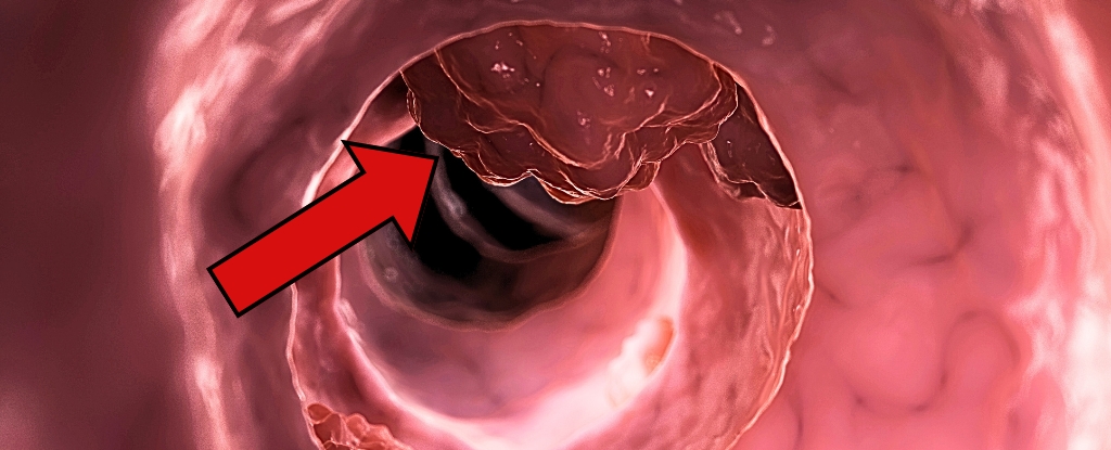 A Common Medicine May Stop Colorectal Cancer From Returning : ScienceAlert