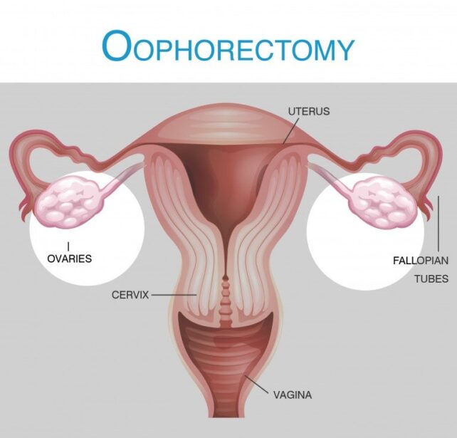 Oophorectomy