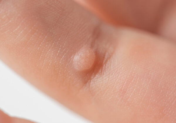 The Virus Almost Everyone Gets: What You Need to Know About HPV ...