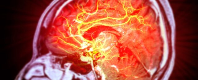 Stem Cells Repair Brain Damage Caused by Stroke in Mice