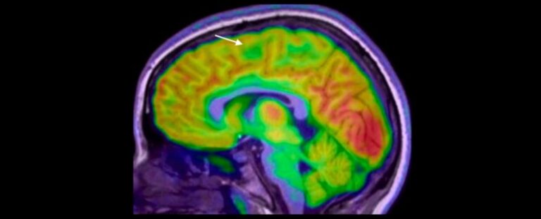 New AI Tool Finds Hidden Brain Lesions That Doctors Miss in Children ...