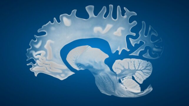 Male Brains Shrink Faster Than Female Brains, Study Finds