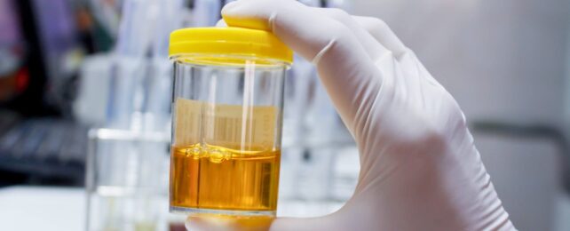 A gloved hand holding urine sample