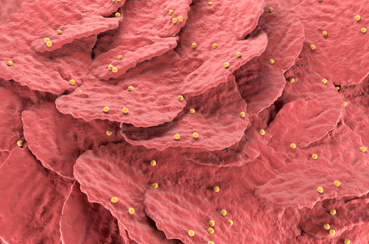 illustration of excessive skin cell growth in psoriasis forming plaques