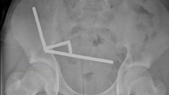 New Zealand Teen Loses Part of His Bowel After Swallowing Nearly 200 Magnets
