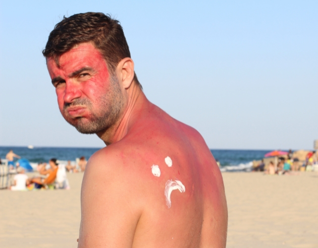 A sunburned man on a beach, looking over his shoulder 