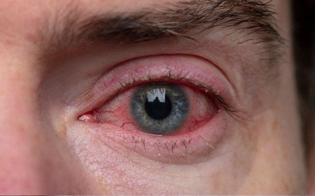 bloodshot eyes