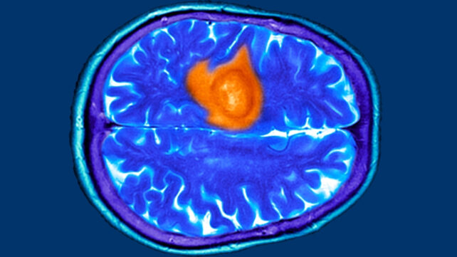 scan of a brain tumor