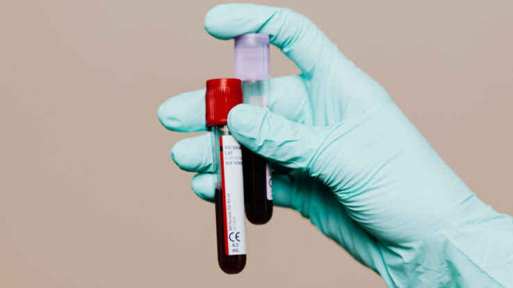 New Chronic Fatigue Syndrome 'Blood Test' Raises Hope And Skepticism