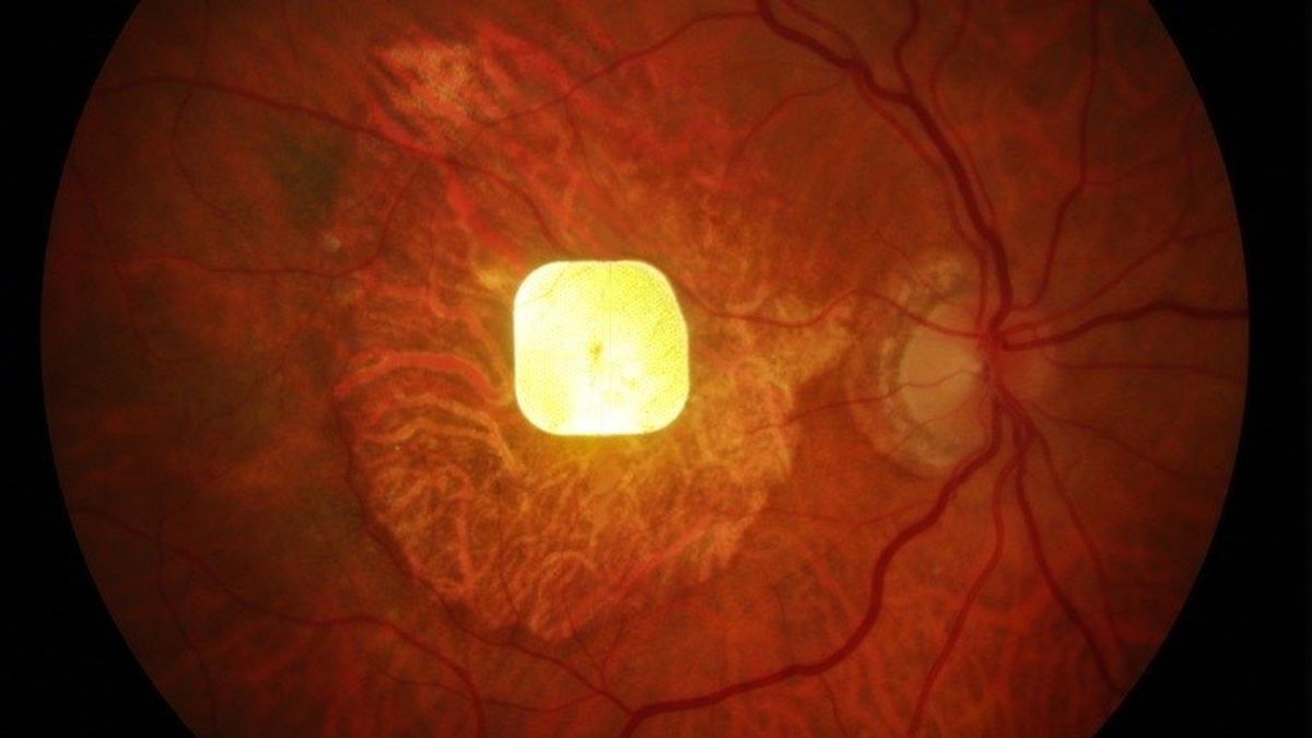 sciencealert.com - Michelle Starr - Revolutionary Prosthetic Eye Chip Restores Sight in Medical First