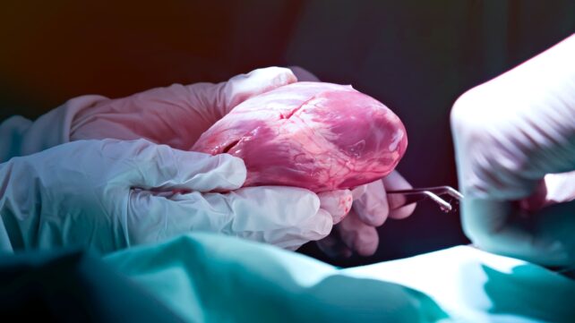 heart transplant