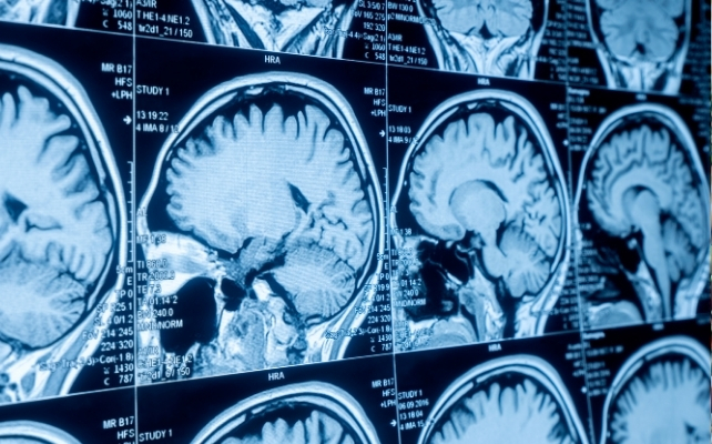 mri scans of a brain