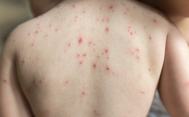 chicken pox on a toddler