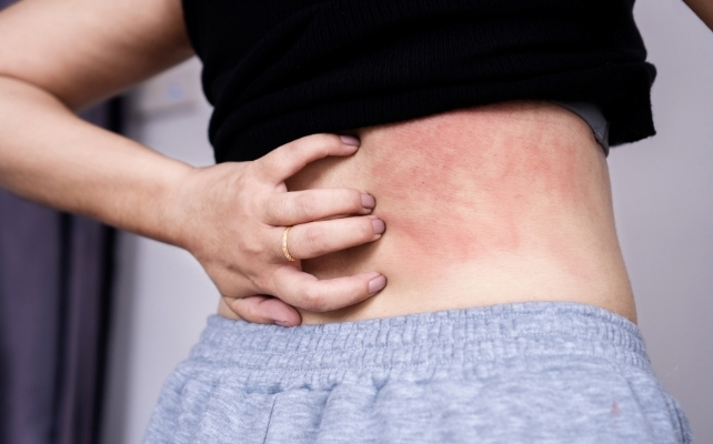 woman with a rash