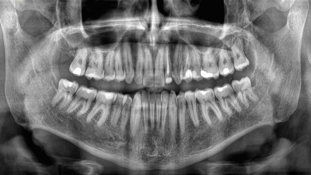 x-ray of mouth