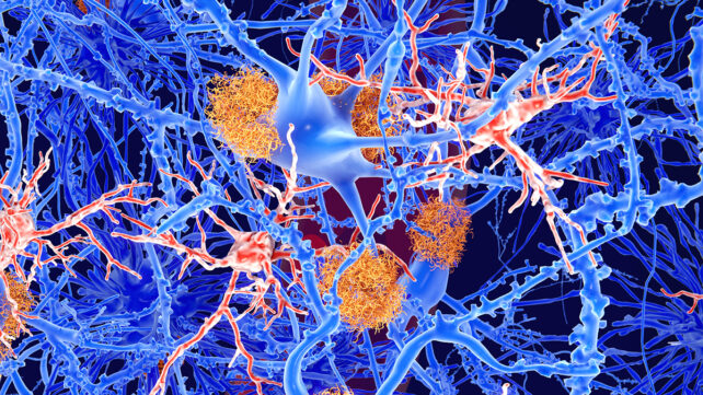 Amyloid-beta plaques in the brain