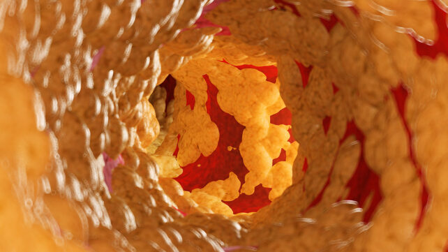 Illustration of fat inside of an artery
