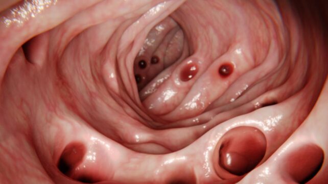 Most People Develop Diverticulosis in Their Gut by Age 80… So What Is It?