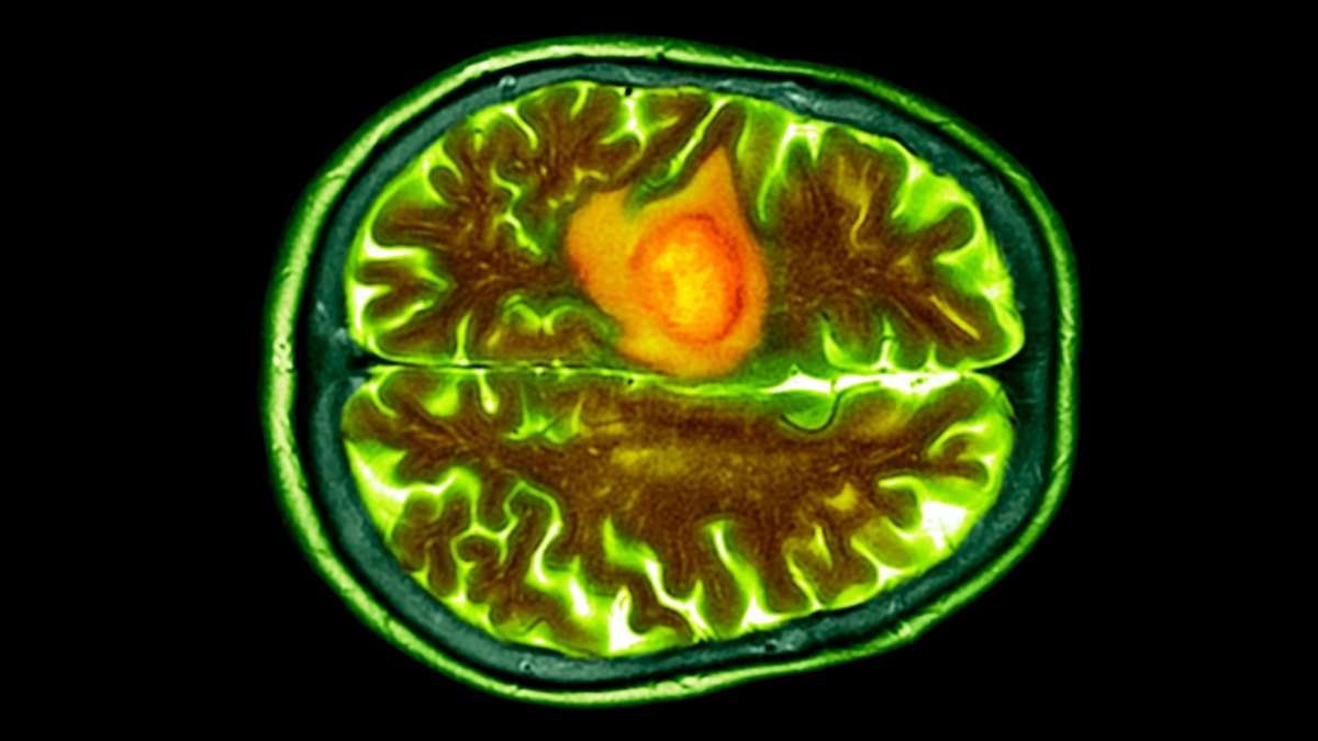 Nasal Drops Could Help Fight a Common And Deadly Brain Cancer