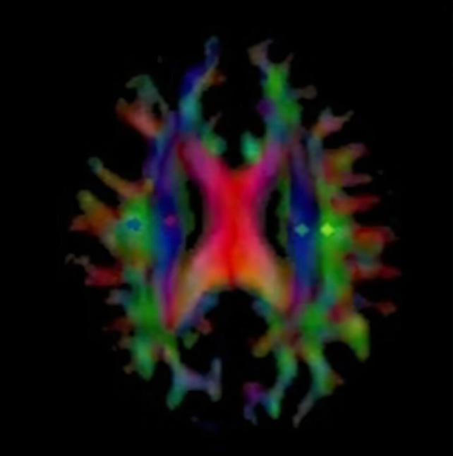 Glymphatic system scan