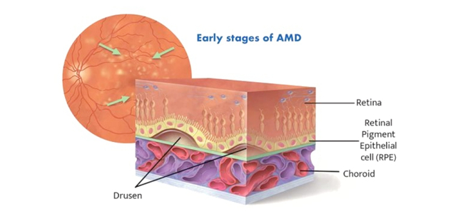 diagram of macular degeneration