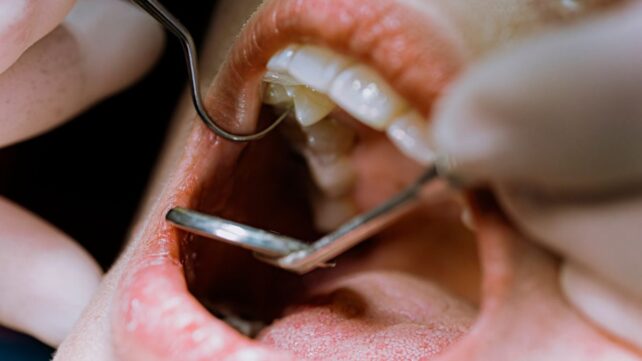 Root Canal Treatment Could Improve Your Blood Sugar Control, Study Suggests