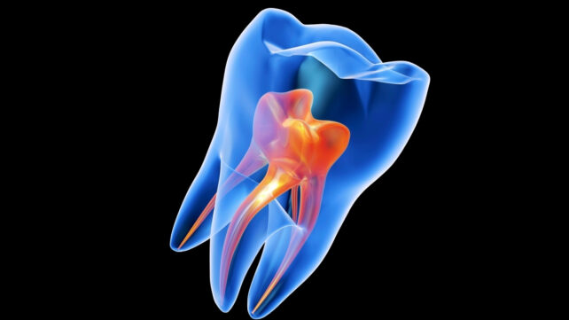 Transparent cross section of a molar tooth showing the pulp chamber in orange
