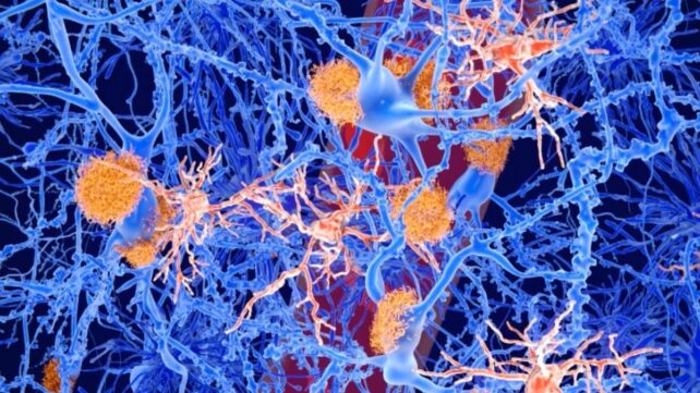 Illustration of amyloid plaques (orange) and microglia cells (red) among neurons