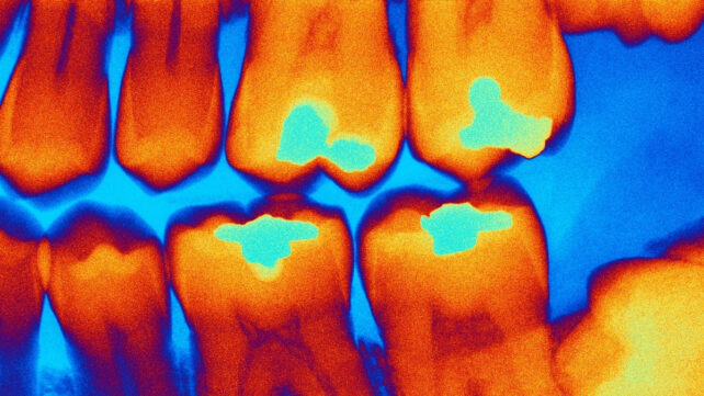 coloured x-ray image of dental fillings in teeth