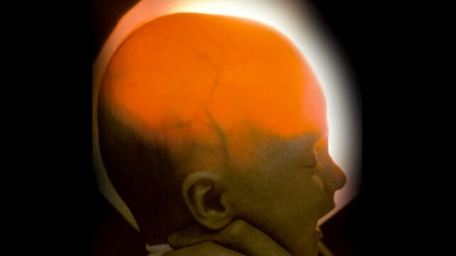 Women Born Missing Most of Her Brain Just Turned 20, Defying Odds