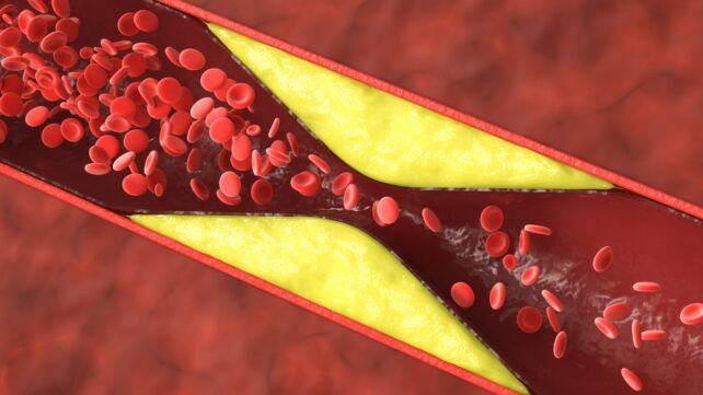 Atherosclerosis concept showing plaque (yellow) leaving only a narrow path for blood flow in an artery