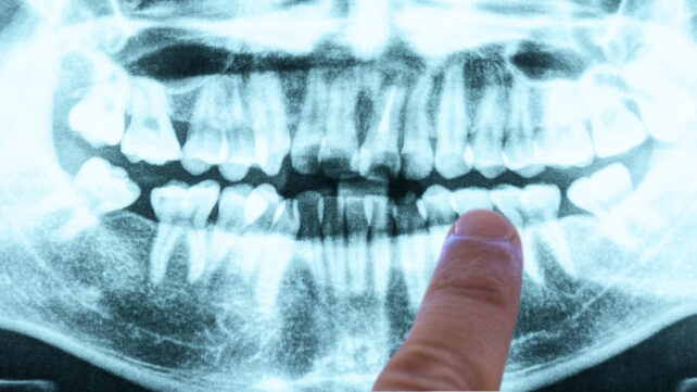 Panoramic dental X-Ray with finger pointing at right side