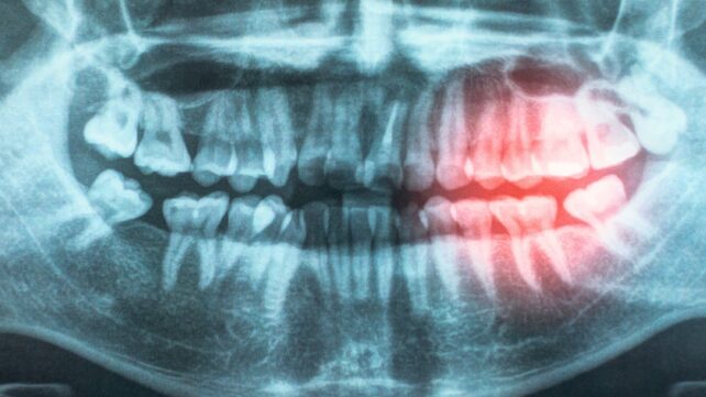 mouth xray